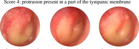 AOM in Kids: Getting It Right .